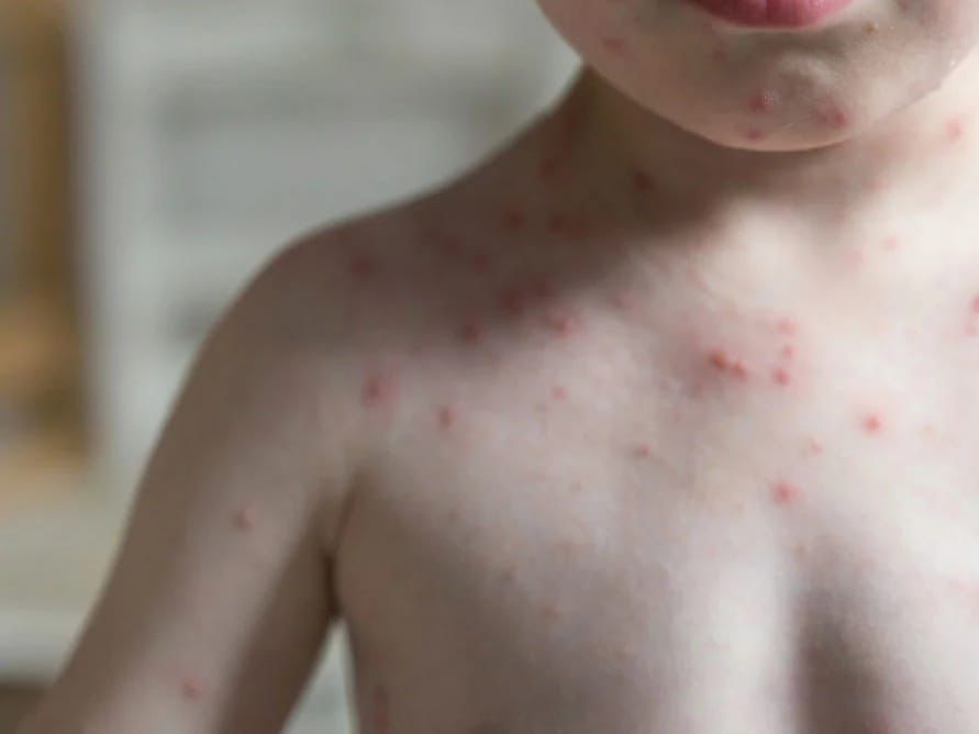 Confirma SSM primeros casos de sarampión en Michoacán